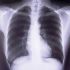 rentgen pluća
